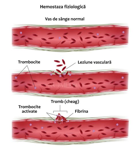 varice și diferență de tromboză